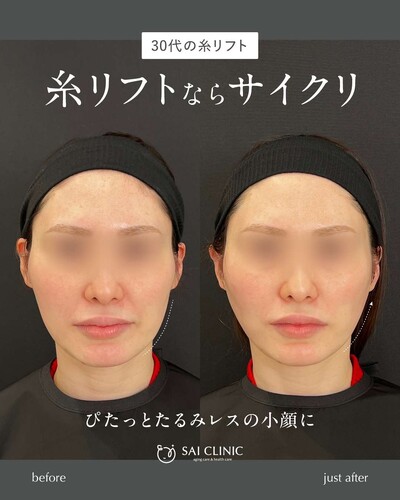 糸リフト（SAI LIFT STANDARD）14本の症例写真