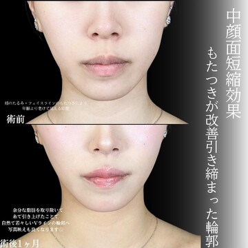 アリエル美容クリニック 大宮院の脂肪吸引の症例写真