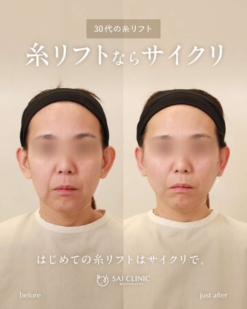 SAI CLINIC （サイクリニック）のリフトアップの症例写真