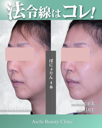 あいちビューティークリニック栄本院のリフトアップの症例写真