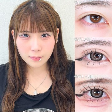 アリエル美容クリニック 大宮院の目・二重整形の症例写真
