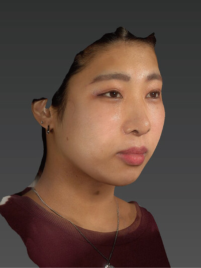 鼻尖縮小+鼻翼縮小の症例写真[アフター]