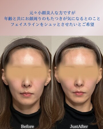 KNOT CLINIC AOYAMAのしわ・たるみ整形(注入、糸、フェイスリフト)の症例写真