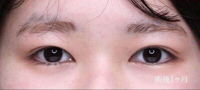 眼瞼下垂手術で自然に目の開きを改善（術後1ヶ月）の症例写真[アフター]