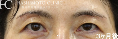眉毛下切開法の症例写真[アフター]