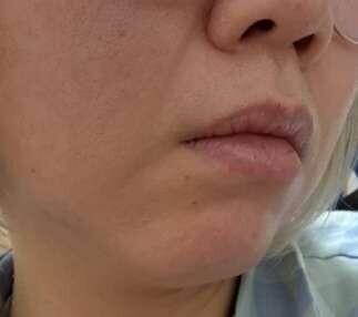 ペルラクリニック神宮前のリフトアップの症例写真[ビフォー]