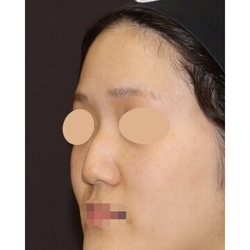 聖心美容クリニックの鼻の症例写真[ビフォー]