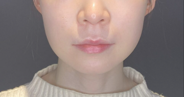 東京美容医療クリニックの口元・唇の整形・人中短縮の症例写真[ビフォー]