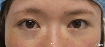 目の下スリーミックス法の症例写真[アフター]