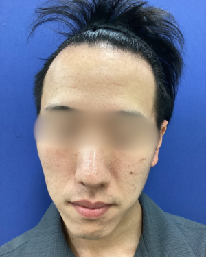 フェミークリニックの症例写真[アフター]