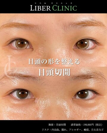LIBER CLINIC （リベルクリニック）の目・二重整形の症例写真