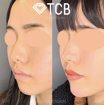オルチャン鼻 韓国美人 鼻尖縮小術 ヒアルロン酸注入 鼻 その他 鼻の整形 の症例写真 画像 Tcb東京中央美容外科 渋谷西口院 Cs 美容医療の口コミ広場