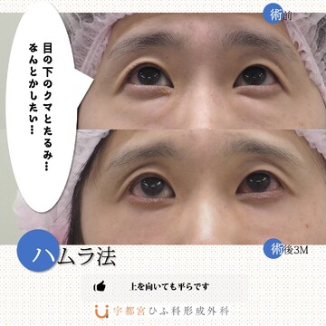 宇都宮ひふ科形成外科の目元・クマ・眉下・涙袋整形の症例写真
