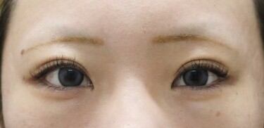目頭切開の症例写真[アフター]