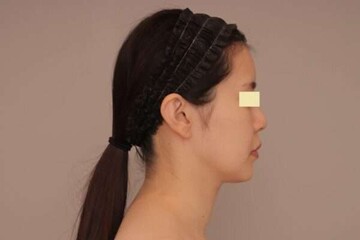Mods Clinic (モッズクリニック)の脂肪吸引の症例写真[ビフォー]