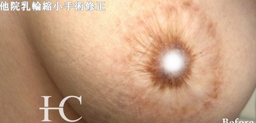 静岡美容外科橋本クリニックの豊胸・胸の整形の症例写真[ビフォー]