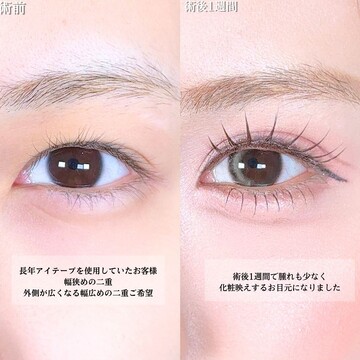 アリエル美容クリニック 大宮院の二重の症例写真
