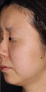 濃いシミ そばかすはピコスポット シミのレーザー治療 その他 シミ 毛穴治療 美白治療 肝斑治療 そばかす治療 老人性色素斑 色素沈着 赤ら顔治療の症例 Select Clinic セレクトクリニック Cs50433 美容医療の口コミ広場