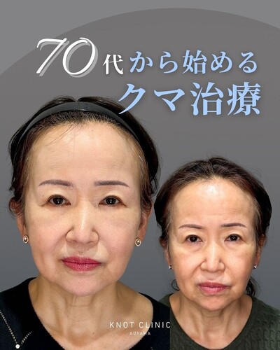 70代から始めるクマ治療の症例写真
