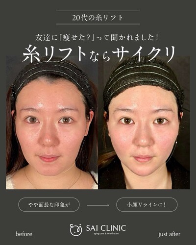 糸リフト：10本の症例写真