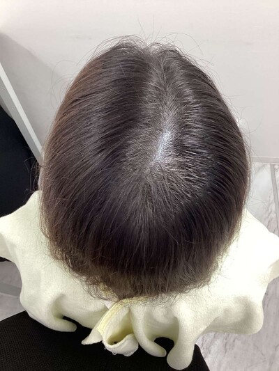 ヘアアートメイク｜50代｜2回の症例写真[アフター]