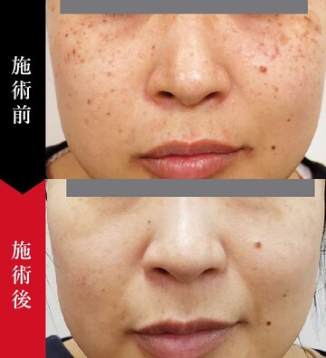 椿クリニックのシミ取り・肝斑・毛穴治療の症例写真