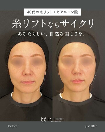 SAI CLINIC （サイクリニック）のリフトアップの症例写真
