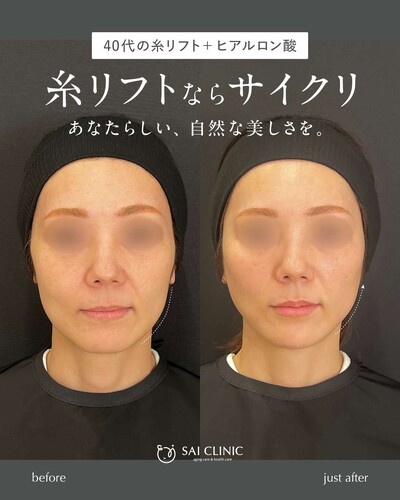 糸リフト（SAI LIFT PERFECT）＋ヒアルロン酸の症例写真