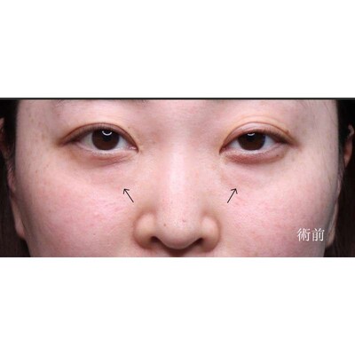 裏ハムラ法でふくらみと凹みの影を解消（術後1ヶ月）の症例写真[ビフォー]