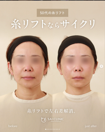 SAI CLINIC （サイクリニック）のリフトアップの症例写真