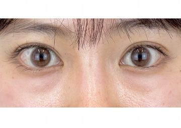 AI Beauty Clinicの目元・クマ・眉下・涙袋整形の症例写真[ビフォー]