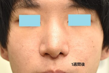 医療法人秀晄会 心斎橋コムロ美容外科クリニックの鼻の整形の症例写真[ビフォー]