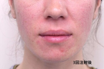 医療法人秀晄会 心斎橋コムロ美容外科クリニックの症例写真[アフター]