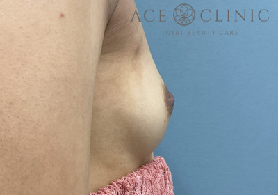 乳頭縮小症の症例写真[アフター]