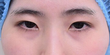 医療法人秀晄会 心斎橋コムロ美容外科クリニックの目・二重整形の症例写真[ビフォー]
