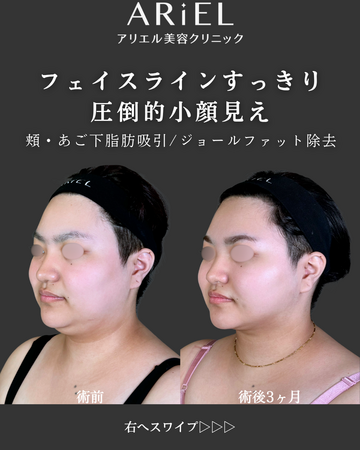 アリエル美容クリニック 郡山院の脂肪吸引の症例写真