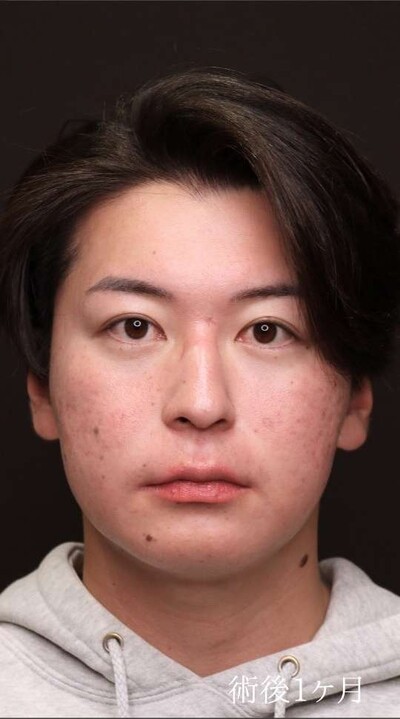 裏ハムラ法で男性の目の下のクマ・疲れ顔を改善（術後1ヶ月）の症例写真[アフター]