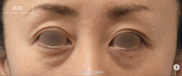 スキンクリニック藤枝の目元・クマ・眉下・涙袋整形の症例写真[ビフォー]