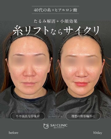 SAI CLINIC （サイクリニック）のリフトアップの症例写真