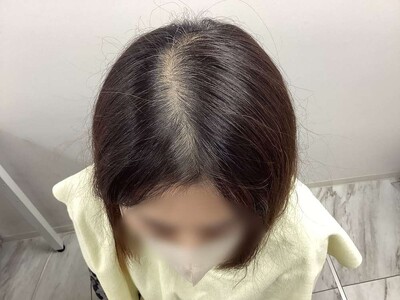 ヘアアートメイク｜50代｜2回の症例写真[ビフォー]