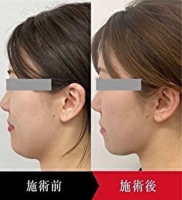 椿クリニックの輪郭・顎・エラ・額・小顔整形の症例写真
