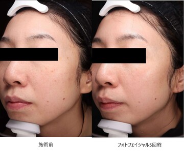 とりい皮膚科クリニックのシミ・肝斑の症例写真