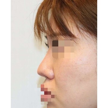 聖心美容クリニックの鼻の症例写真[ビフォー]