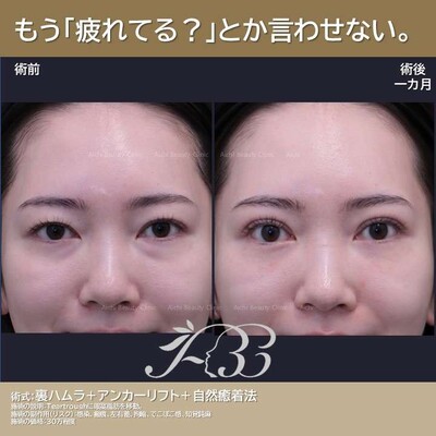 くま治療と二重治療同時に！の症例写真