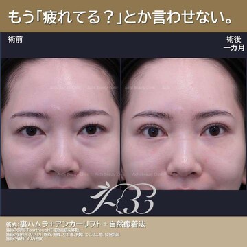 あいちビューティークリニック栄本院の目元・クマ・眉下・涙袋整形の症例写真
