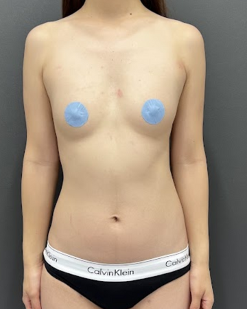 Plume Clinicの豊胸・胸の整形の症例写真[ビフォー]