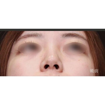 聖心美容クリニックの鼻の症例写真[ビフォー]