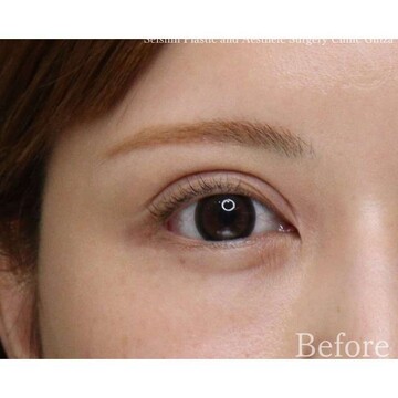 聖心美容クリニックの二重の症例写真[ビフォー]