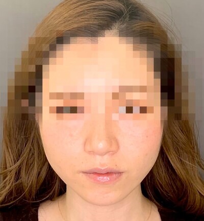 小顔整形 シャープな小顔に 顎の整形 ヒアルロン酸注入 輪郭 顎 その他 輪郭整形 エラ 小顔ボトックスの症例写真 画像 Tcb東京中央美容外科 渋谷西口院 Cs507 美容医療の口コミ広場