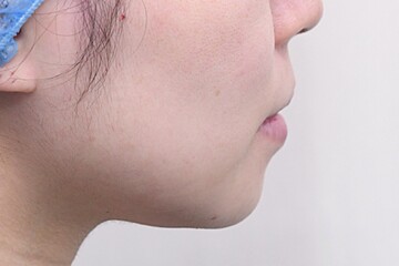 医療法人秀晄会 心斎橋コムロ美容外科クリニックのしわ・たるみ整形(注入、糸、フェイスリフト)の症例写真[ビフォー]